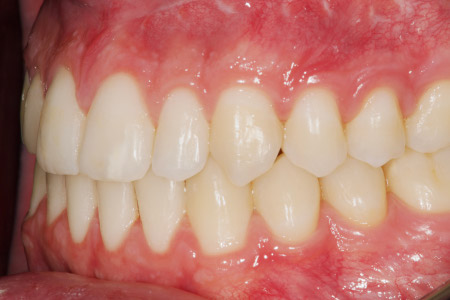 Fase final lateral 1