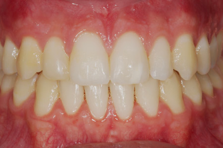 Fase final frontal