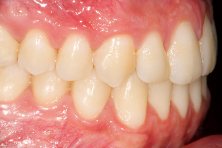 Fase final lateral 2