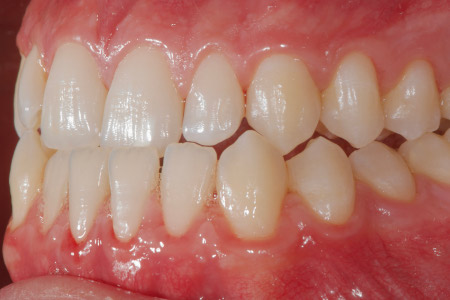 preortodoncia lateral 1