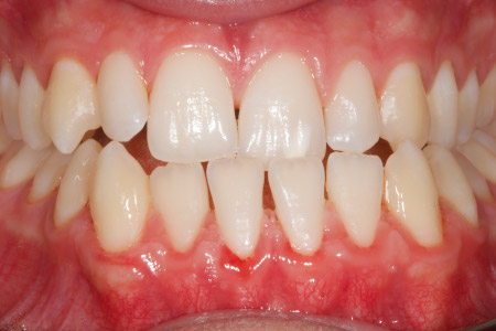preortodoncia frontal