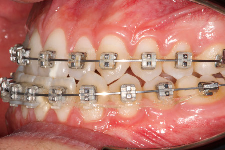 Prequirúrgica lateral 1